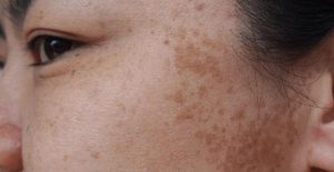 Nám thường biểu hiện qua các đốm hoặc mảng da sẫm màu