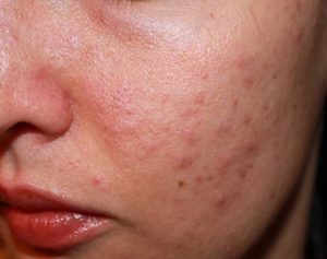 Dị ứng da tại chỗ khiến da bị tổn thương và dễ bị nám