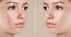 Khi kết hợp hai sản phẩm đều đặn mức độ mụn sau khoảng 2–4 tuần sử dụng.