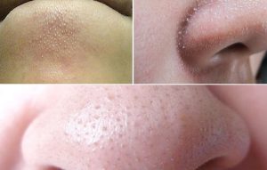 Viên uống mụn Zikii có tác dụng làm sạch lỗ chân lông, ngăn ngừa sự hình thành của mụn cám