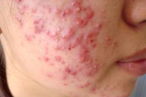 Viên uống mụn Zikii giúp giảm sưng, làm dịu da và ngăn ngừa tình trạng viêm nhiễm lan rộng